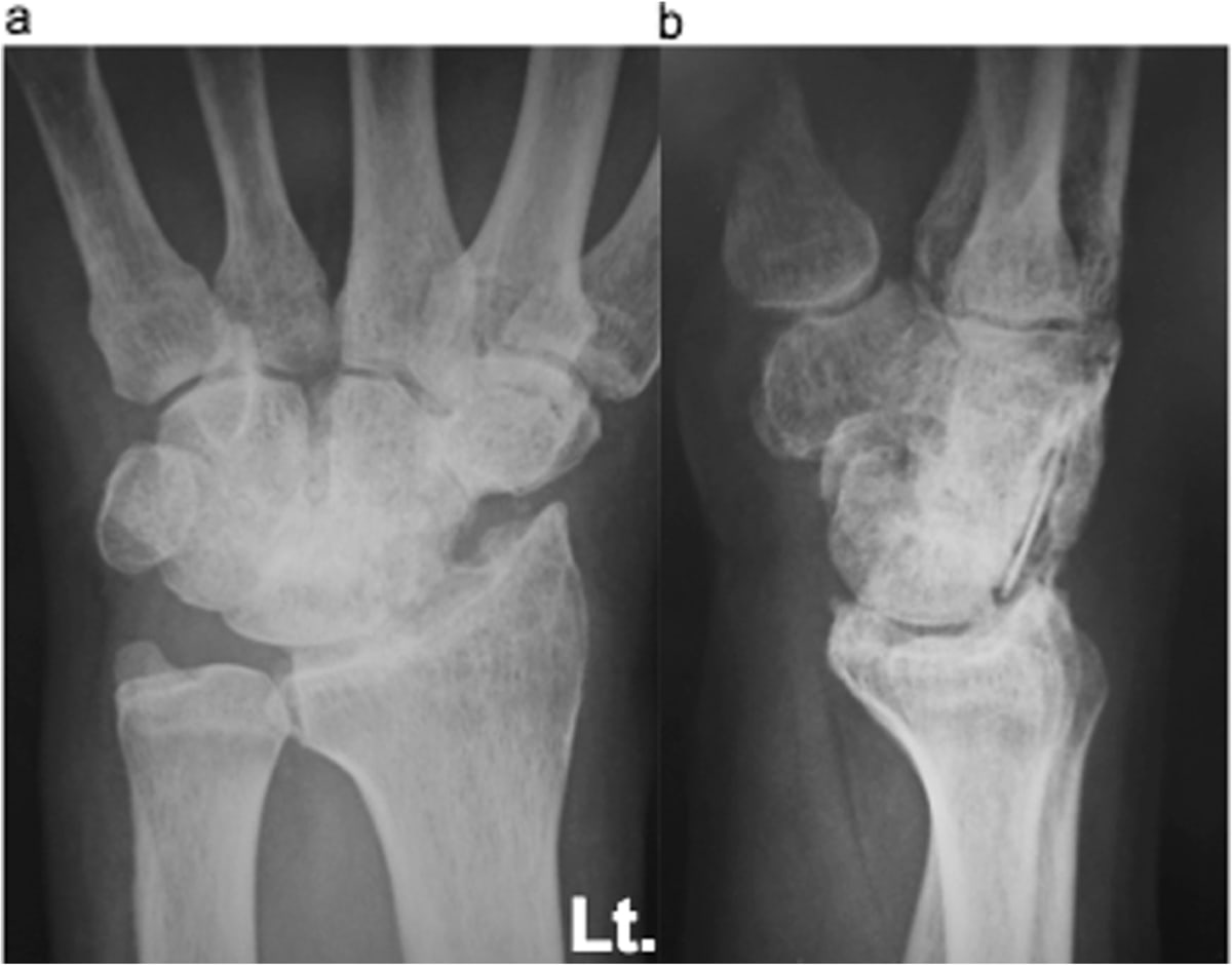 Wrist Implant